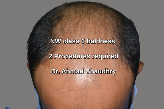 Baldness Okara patient